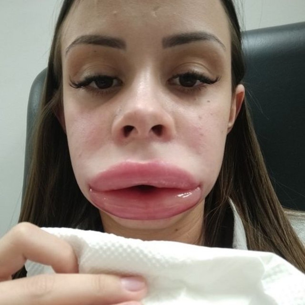 Após preenchimento labial, Pamela Andrade teve forte inchaço na boca, no rosto, nos olhos — Foto: ARQUIVO PESSOAL/BBC