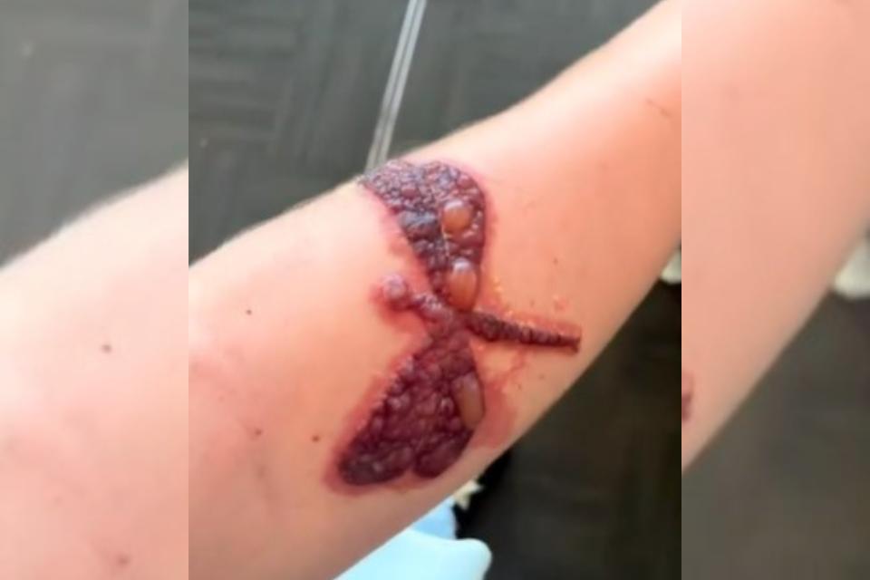 As tatuagens de henna comuns no verao podem causar queimaduras